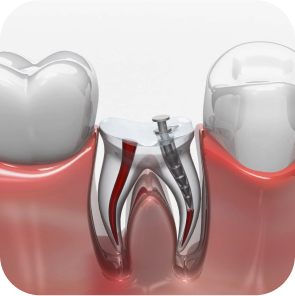 Root Canal