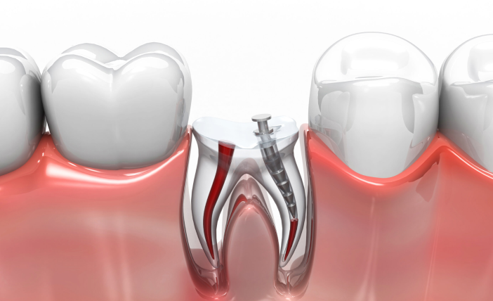 Root Canal
